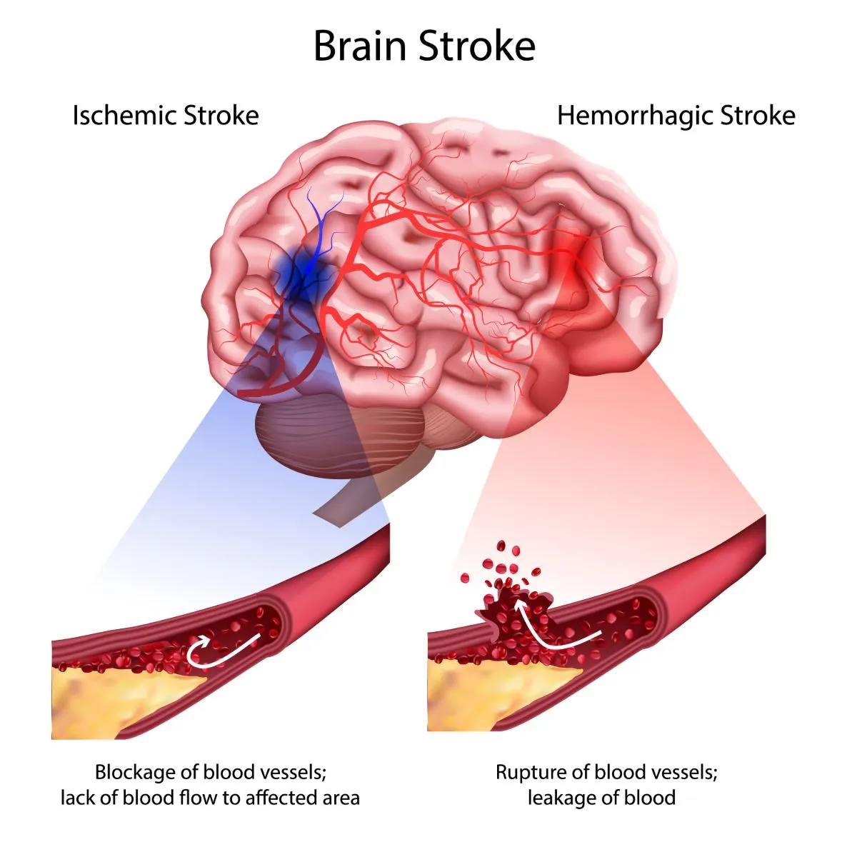 Stroke Prevention